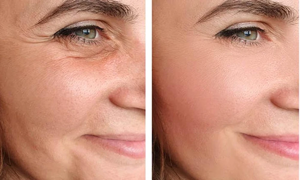 A Smarter Way to Lift Your Face Without Surgery